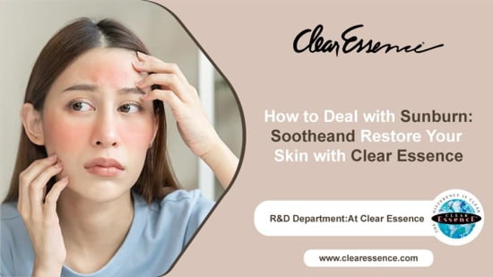 How to Deal with Sunburn