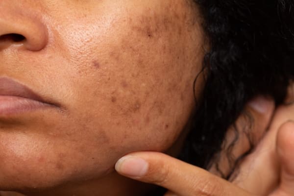 hyperpigmentation