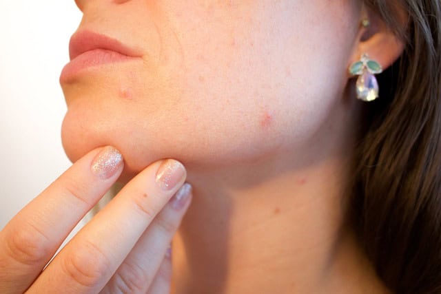 Impact of Hormones on Skin Health