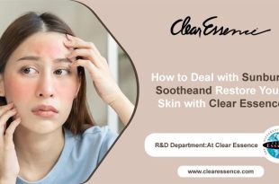 How to Deal with Sunburn: Soothe and Restore Your Skin with Clear Essence