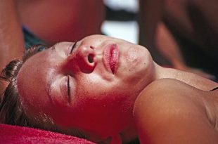 How to Deal with Sunburn